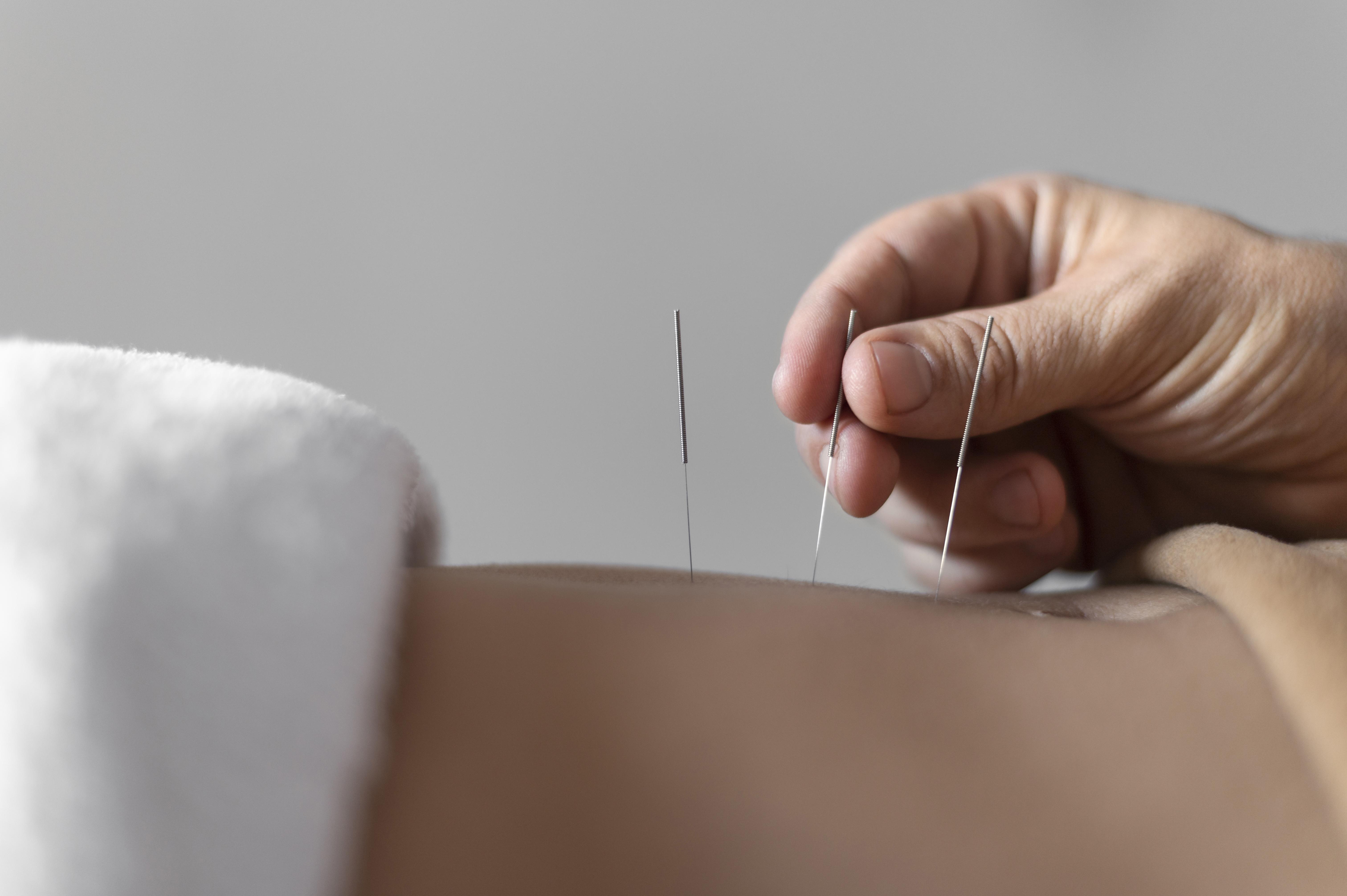 tcm acupuncture